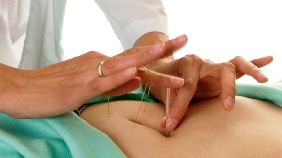 Acupuncture needles placed on the abdomen for fertility support