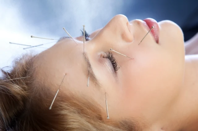 Acupuncture needles placed around the face and ear