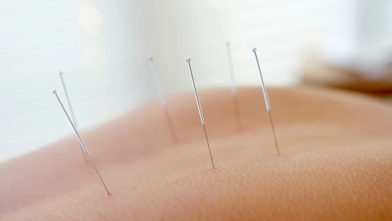 Fine needles inserted along a patient's upper back