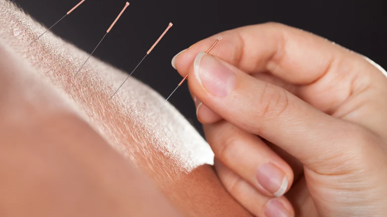 Acupuncture needles being placed to relieve shoulder pain